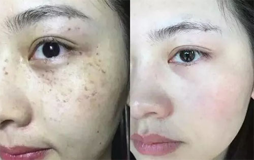 祛斑方法哪种效果最好？