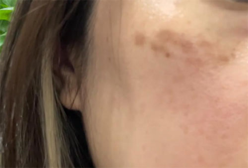 祛斑反黑色素沉着怎么消除？